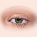 Moderate ptosis