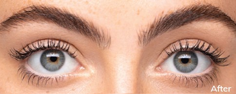Image of a woman’s eyes before and after using Upneeq