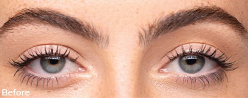 Image of a woman’s eyes before and after using Upneeq